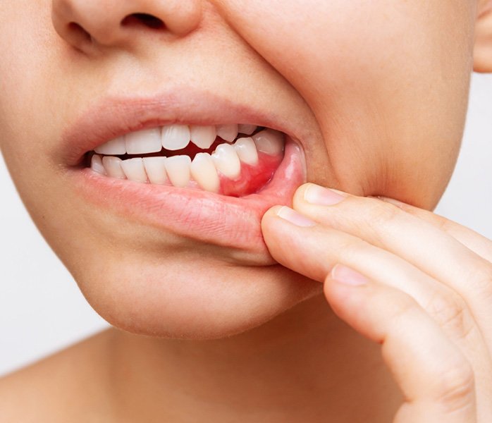 Nose-to-neck view of woman pulling down lower lips with several fingers to reveal red gums