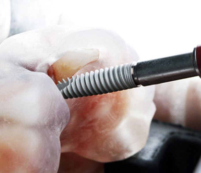 Close-up of dental implant being placed in bone