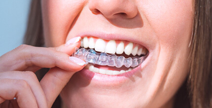 Closeup of woman putting on clear aligner 